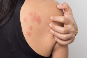 Dị ứng da cách khắc phục
