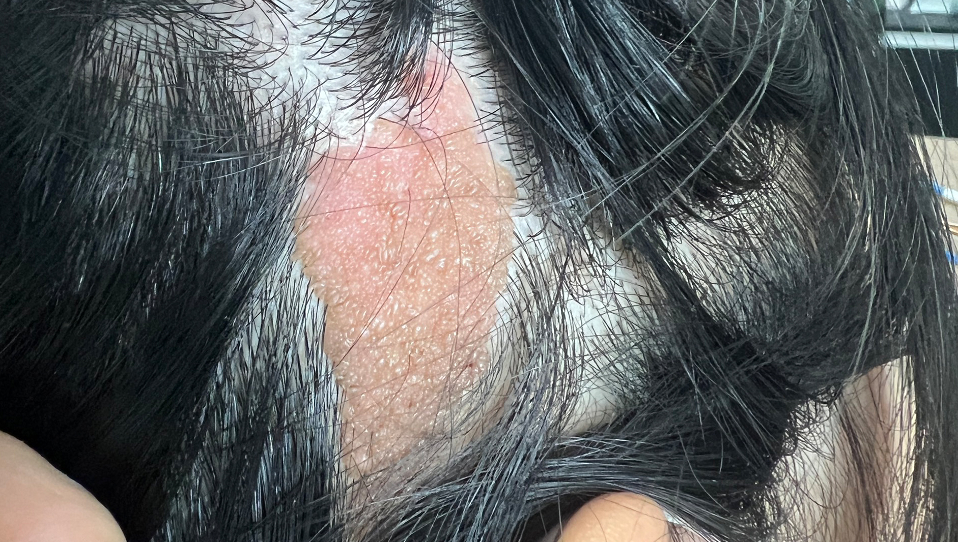 nevus bã