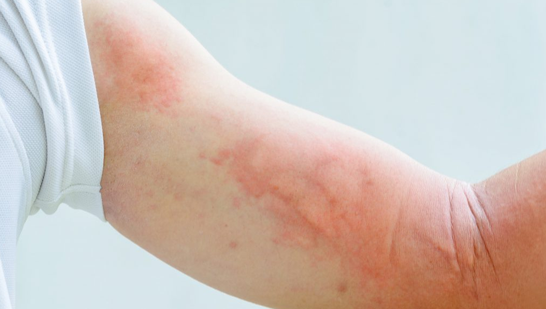 viêm da tiếp xúc nước mưa